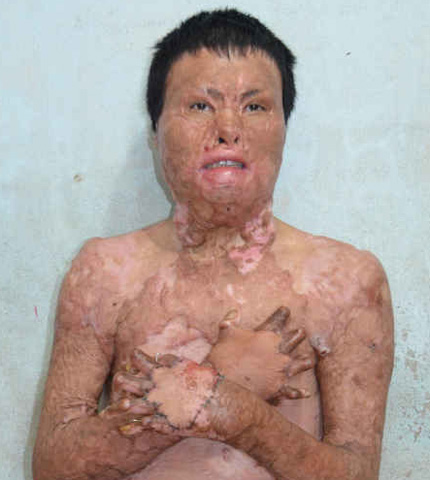 Sự hồi sinh kỳ diệu của ch&agrave;ng trai &ldquo;thập tử nhất sinh&rdquo; sau trận bỏng kinh ho&agrave;ng 2