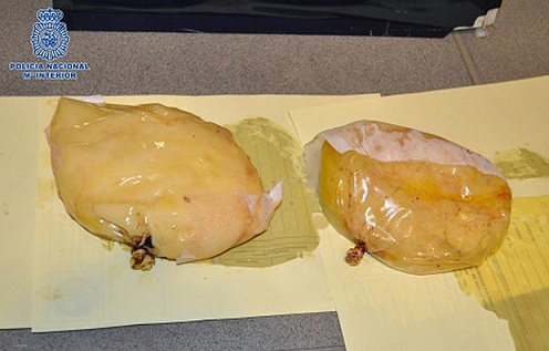 R&ugrave;ng m&igrave;nh cấy "độn ngực" bằng 1,3kg cocaine 1