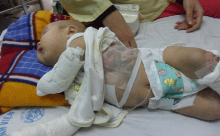 Tiếng khóc xé lòng của bé 5 tháng tuổi bị rụng ngón, lở loét khắp cơ thể 2