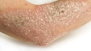 Ngại giao tiếp v&igrave; vẩy nến 1