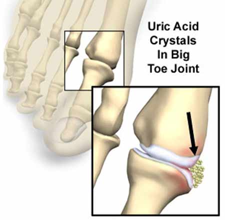 Nồng độ axit uric trong máu cao – Có phải mắc gút? 1 Nồng độ axit uric trong máu cao – Có phải mắc gút? 1