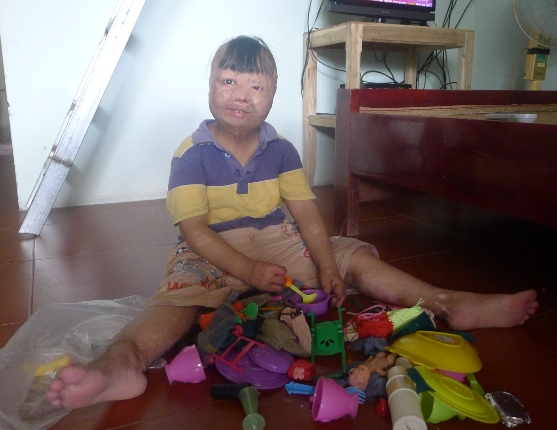 Nghẹn l&ograve;ng cảnh sinh hoạt đời thường ch&aacute;u b&eacute; bị cha đốt 3 năm về trước 5