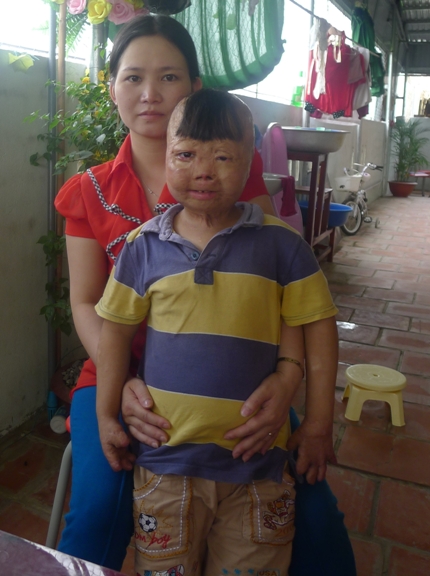 Nghẹn l&ograve;ng cảnh sinh hoạt đời thường ch&aacute;u b&eacute; bị cha đốt 3 năm về trước 13