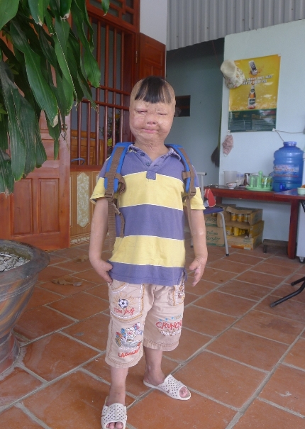 Nghẹn l&ograve;ng cảnh sinh hoạt đời thường ch&aacute;u b&eacute; bị cha đốt 3 năm về trước 9