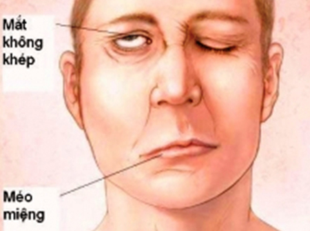 Dễ méo miệng, liệt mặt vì thức khuya 1