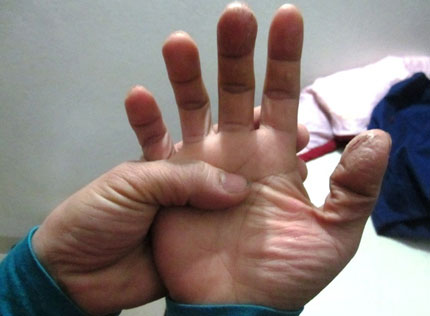 Trị cước ch&acirc;n tay 1