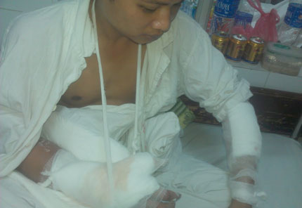 Tranh giành bạn gái, chém cụt tay tình địch 1 Tranh giành bạn gái, chém cụt tay tình địch 1