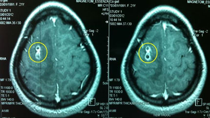 Tổn thương não vì nhiễm ký sinh trùng từ thú nuôi 1