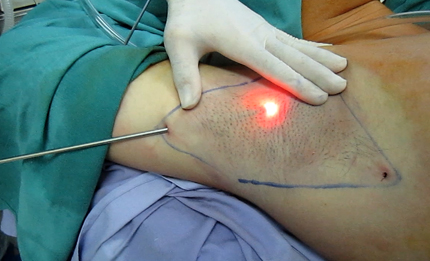 Khi nào nên cắt tuyến mồ hôi? 1 Khi nào nên cắt tuyến mồ hôi? 1