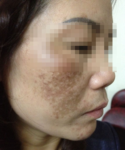 Mất tiền, hỏng da v&igrave; d&ugrave;ng kem chống nắng 1