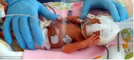Sức sống kì diệu của bé gái nhỏ bằng một bàn tay người lớn 4 Sức sống kì diệu của bé gái nhỏ bằng một bàn tay người lớn 4