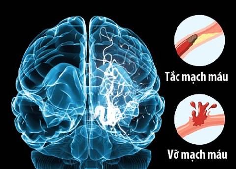 Đột quỵ não đang tấn công giới trẻ 2