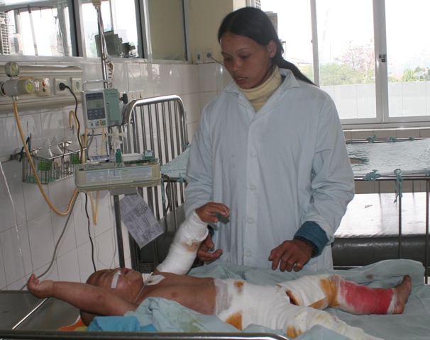 Kinh ho&agrave;ng trẻ em bị bỏng ng&agrave;y r&eacute;t đậm 2