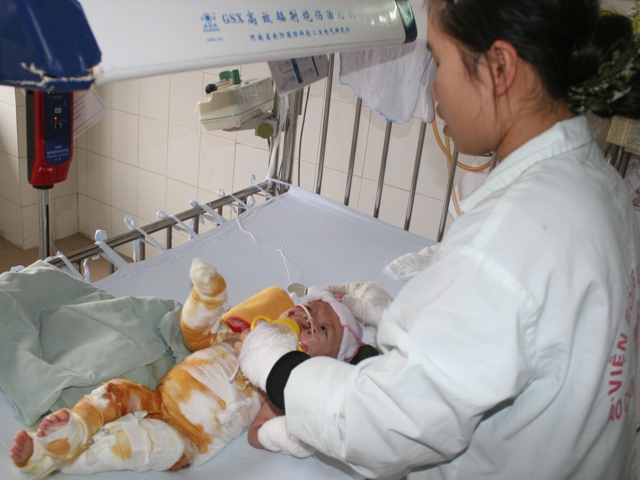 Kinh ho&agrave;ng trẻ em bị bỏng ng&agrave;y r&eacute;t đậm 1