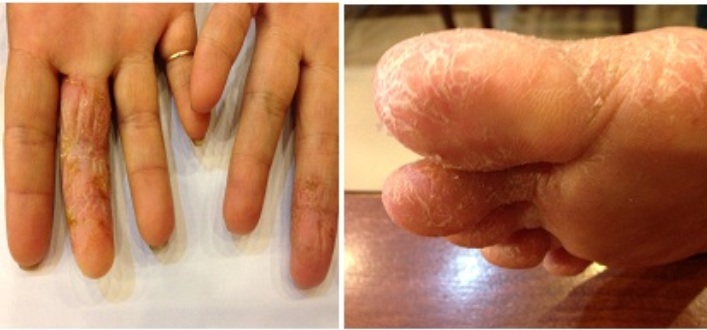 Phương thuốc qu&yacute; đặc trị Bệnh &Aacute; sừng (ch&agrave;m kh&ocirc;) 1
