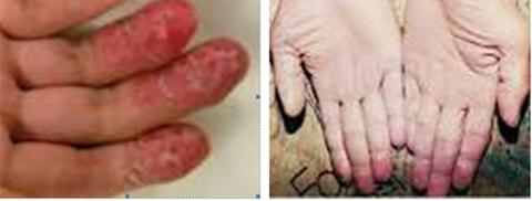 Trị dứt điểm bệnh á sừng (chàm khô) 2 Trị dứt điểm bệnh á sừng (chàm khô) 2