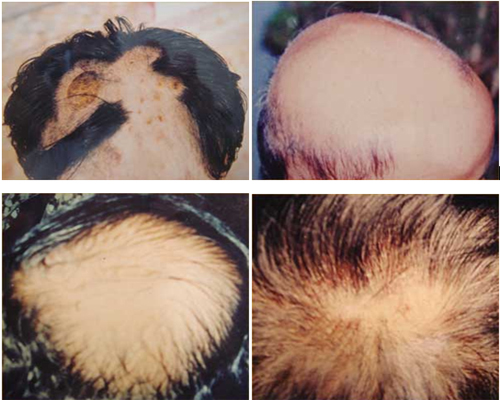 Bí quyết chữa dứt điểm bệnh rụng tóc 2