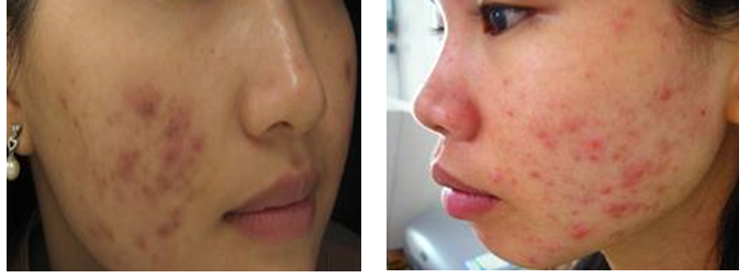 Tư vấn điều trị mụn ở vùng mặt 1