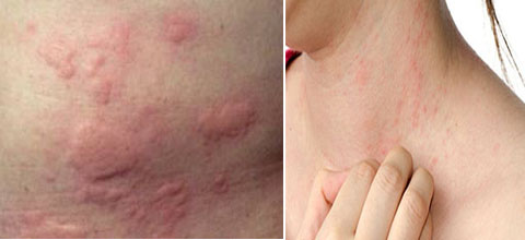 Ngứa kh&ocirc;ng d&aacute;m g&atilde;i bệnh g&igrave;? 1