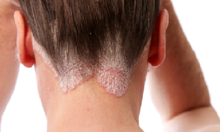 Bước tiến mới trong điều trị bệnh vảy nến 3 Bước tiến mới trong điều trị bệnh vảy nến 3