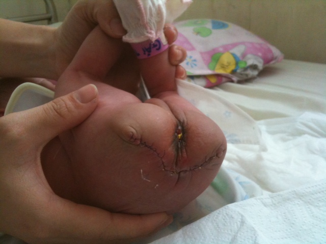 Phẫu thuật lấy khối u nặng 0,5kg ở vùng hậu môn bé sơ sinh 2