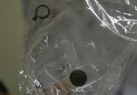 Vi&ecirc;n pin &ldquo;sống&rdquo; trong mũi em b&eacute; 10 tuổi hơn 5 năm nay 1