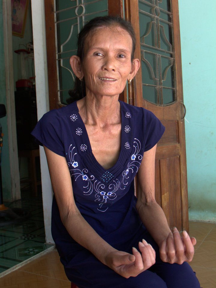 Đ&atilde;i v&agrave;ng bằng thủy ng&acirc;n bị nhiễm độc nặng 1