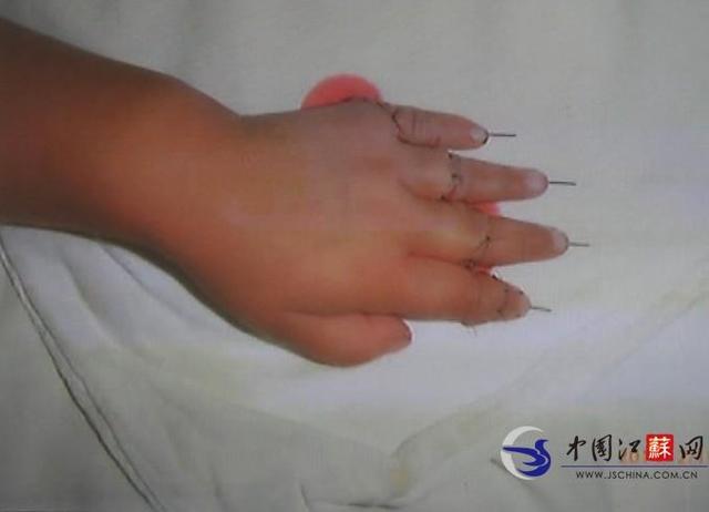 Bé gái 2 tuổi nghịch dao chặt đứt 4 ngón tay 3 Bé gái 2 tuổi nghịch dao chặt đứt 4 ngón tay 3