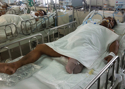 Mất ch&acirc;n v&igrave; chủ quan khi bị ch&oacute; cắn 1