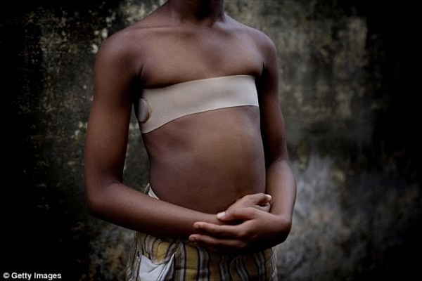 Những gia đình giàu có tại Cameroon thay vì “ủi ngực” sẽ bắt các bé gái đeo những chiếc đai trên ngực để ngăn chặn sự phát triển của bộ ngực. 