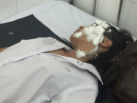 Nữ sinh bị bỏng axít tại vùng mặt.