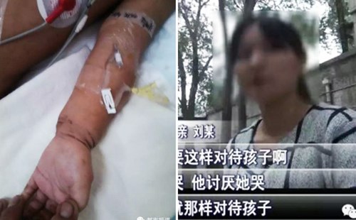 
Hình ảnh cánh tay đầy vết thương của em bé (trái) và chân dung người mẹ vô tâm (phải).

