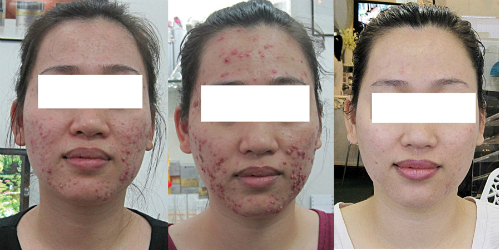Da mặt trầm trọng sau khi ngưng dùng mỹ phẩm chứa corticoid, người phụ nữ phải trải qua hơn 1 năm điều trị để khôi phục làn da. Ảnh: H.H