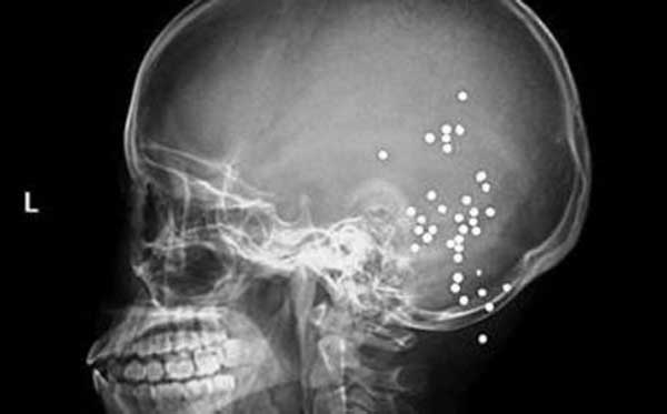 Ảnh chụp x-quang những vi&ecirc;n đạn bi sắt nằm trong đầu bệnh nh&acirc;n. Ảnh: 163