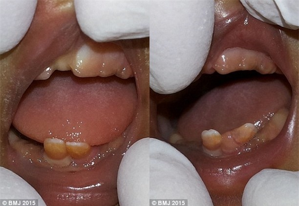 Hai em b&eacute; sơ sinh đ&atilde; mọc răng ngay từ khi mới ra đời.