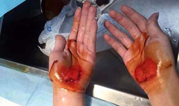 Bàn tay trầy máu của một em học sinh sau khi bị giáo viên phạt. Ảnh: CEN