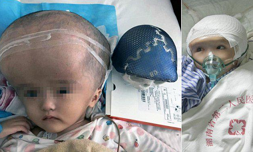 
Bé gái Han Han là bệnh nhi đầu tiên bị não úng thủy được ghép thành công hộp sọ 3D. Ảnh: Medical Daily.
