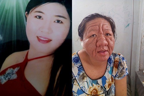 Chứng lão hóa do hậu quả của việc lạm dụng thuốc bôi chứa corticoid khiến gương mặt của cô gái 29 tuổi Thạch Thị Tha Ri như bà lão 70. Ảnh: Khoa học Đời sống.