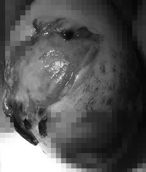 
Phần tử cung tuột ra bên ngoài âm đạo của cụ Đ to gần bằng quả bưởi bị trầy xước do cụ tự cắt cứa. Ảnh (chụp trước khi phẫu thuật).
