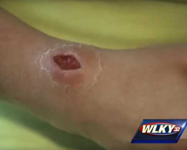 Vết thương ở tay của Audrey Koop. Ảnh:&nbsp;WLKY News