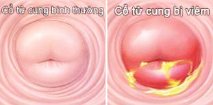 
Khi có biểu hiện ra khí hư nhiều hoặc nghi ngờ lộ tuyến cần đến cơ sở y tế để được điều trị.
