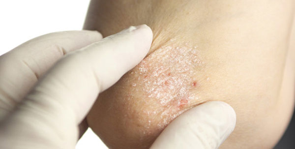 Giữ ẩm cho da là điều cần thiết với bệnh nhân vẩy nến