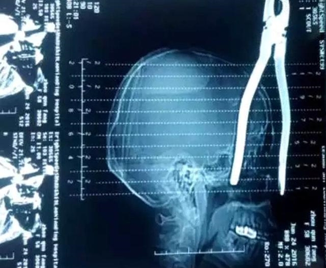 
Phim chụp X-quang vết thương nghiêm trọng của bà Youfang.
