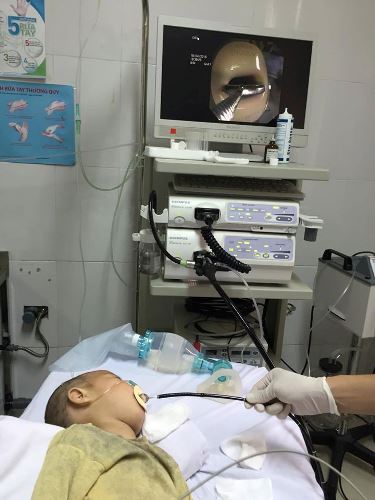 Các bác sĩ Bệnh viện Sản nhi Quảng Ninh gắp bị vật ra khỏi thực quản bệnh nhân. Ảnh: Bệnh viện cung cấp