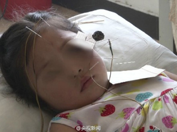 
Bé gái 5 tuổi phải nhập viện vì mặt bị tê liệt sau khi nằm điều hòa liên tục với nhiệt độ thấp (Ảnh minh họa)
