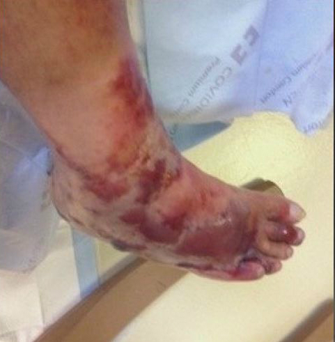 Chân phải của Brian Parrott bị vi khuẩn ăn thịt tấn công. Ảnh: Foxnews.