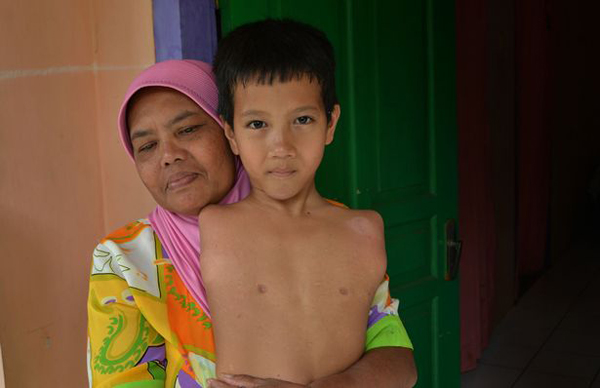 
Ngay từ khi sinh ra, Tiyo Satrio (làng Penawangan, West Java, Indonesia) đã không có 2 tay, 2 chân như những đứa trẻ bình thường khác. Khi mang thai cậu bé, bà MiMi không hề biết con mình gặp phải dị tật này. Thậm chí khi đã sinh Tiyo Satrio, bà mụ đỡ đẻ vẫn nói cậu là một cậu bé bình thường, cho đến chiều ngày hôm sau người mẹ mới biết con trai mình không hề bình thường.

