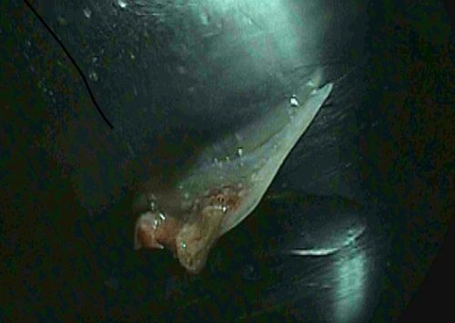 Mảnh xương cá mắc trong thanh quản của bệnh nhân. Ảnh: Bác sĩ Lưu Phương