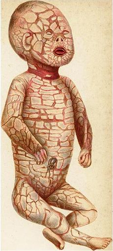 
Hình minh họa trẻ sơ sinh bị Harlequin Ichthyosis. Ảnh: Wikipedia.
