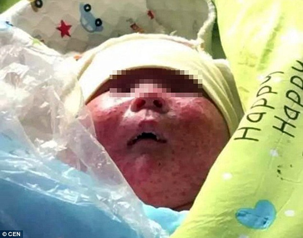 
Cậu bé 1 tháng tuổi được tìm thấy trong tình trạng sức khỏe nguy hiểm, gương mặt chi chít vế muỗi đốt.
